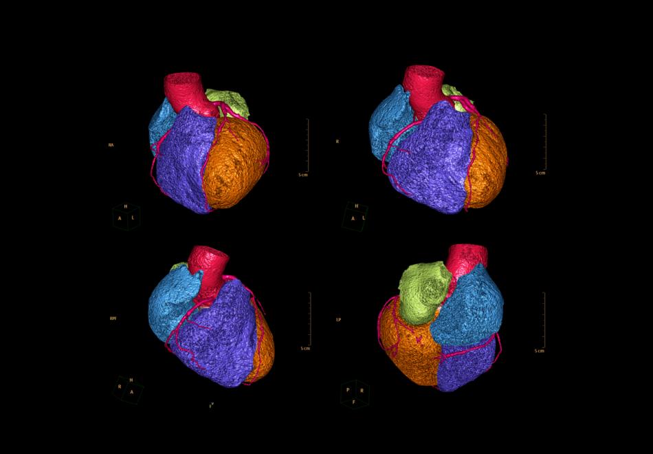 Cardiac CT in pseudo-colours