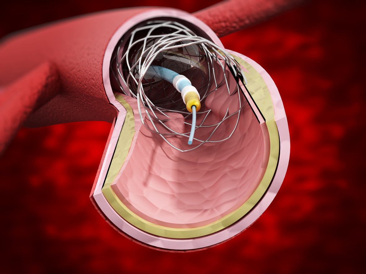 Unveiling the Role of Cardiovascular Surgeons: Do They Perform PCI? – Nursa