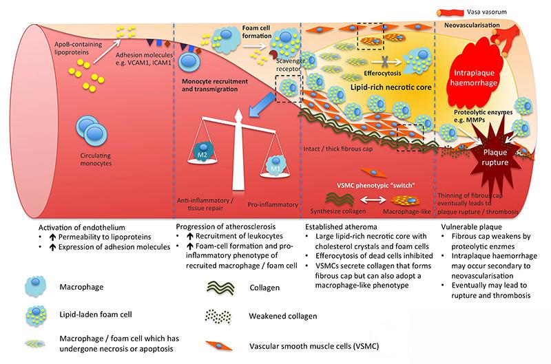 Atherosclerosis progression model