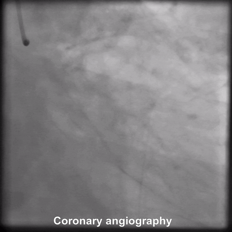 Coronary angiogram animated gif