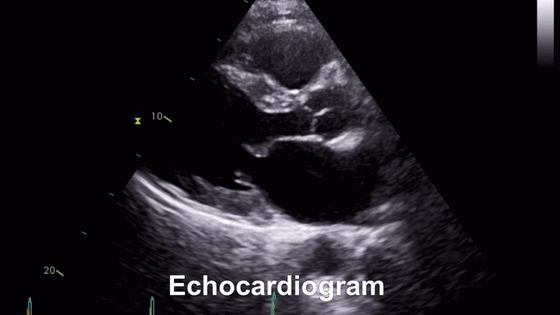 Echocardiogram in animated GIF