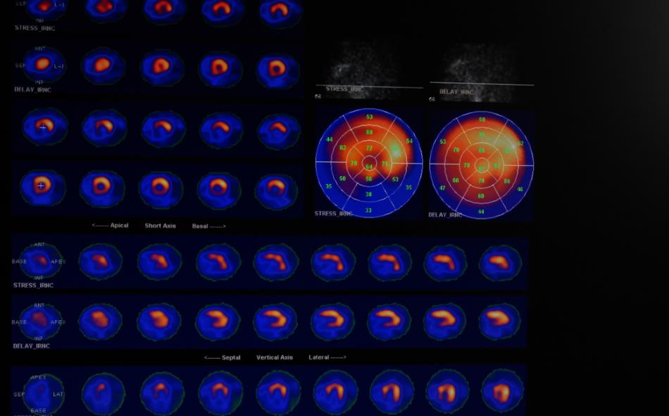 Stress myocardial perfusion study