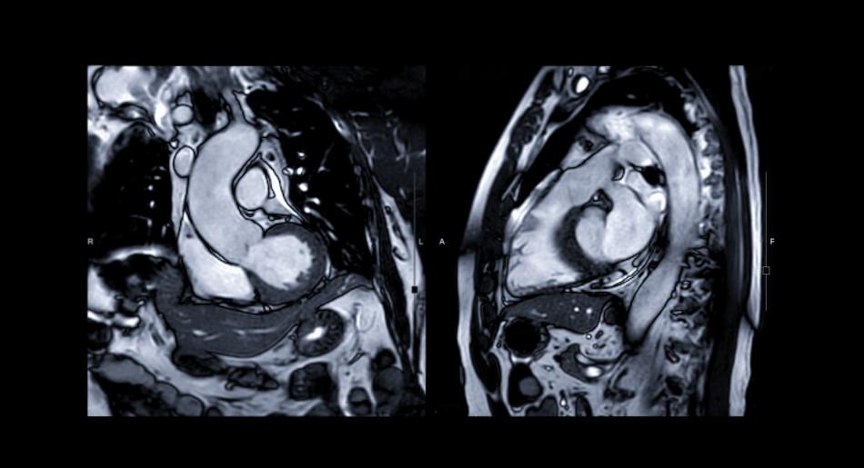 Cardiac MRI