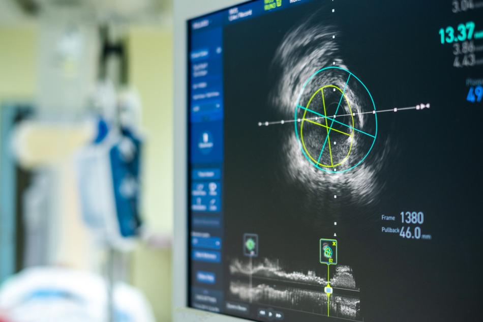 intravascular ultrasound