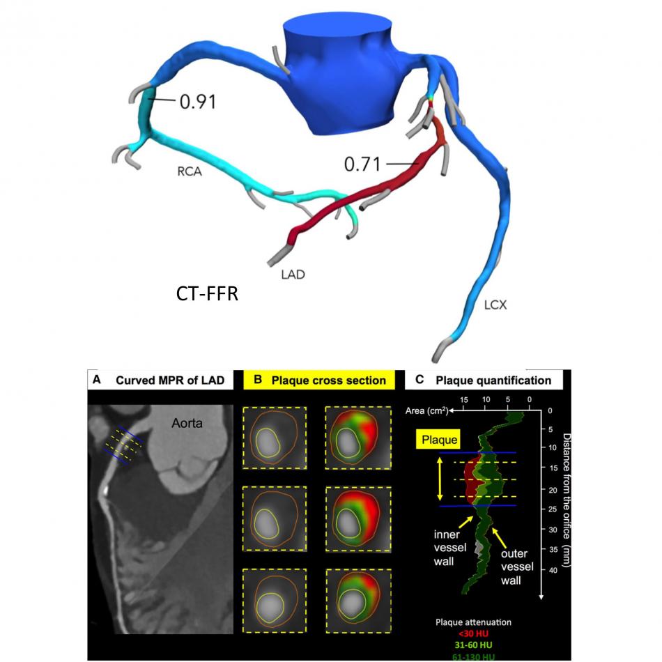 CT plaque analysis