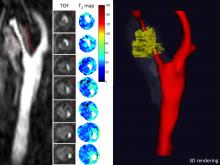 Lipid Quantification MRI